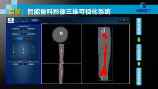 骨科三维可视化系统平台